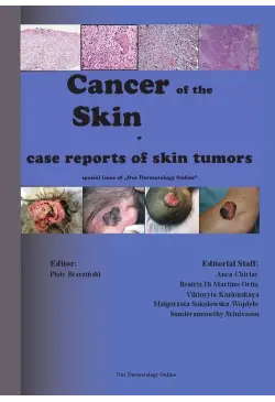 Cancer of the Skin - case...