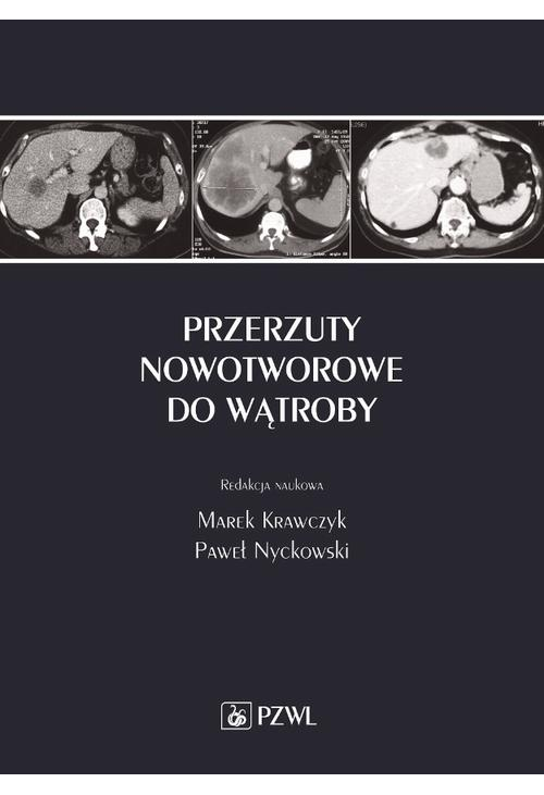 Przerzuty nowotworowe do wątroby